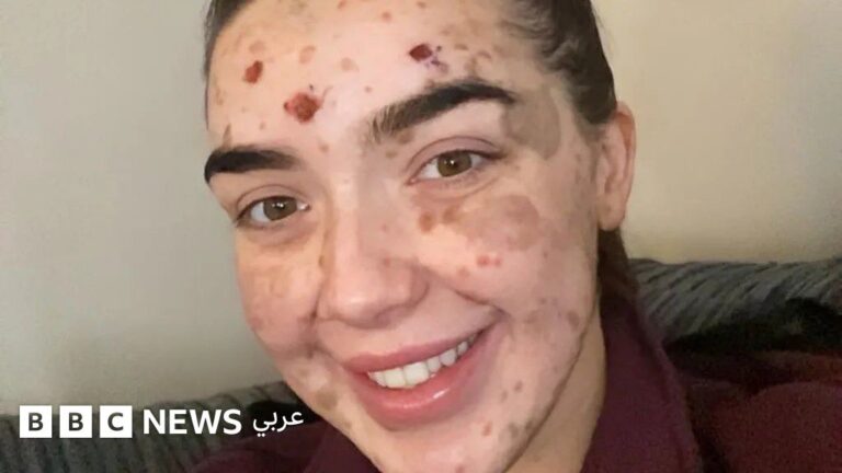 لورا كيلي تتعلم تقبل بشرتها النادرة التي تغطي 98% من جسدها