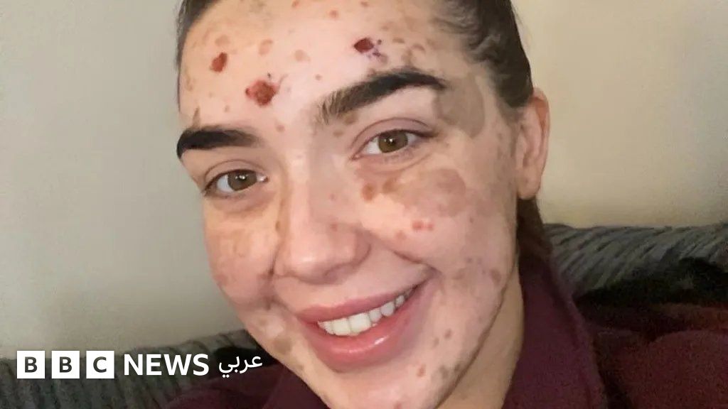 لورا كيلي تتعلم تقبل بشرتها النادرة التي تغطي 98% من جسدها