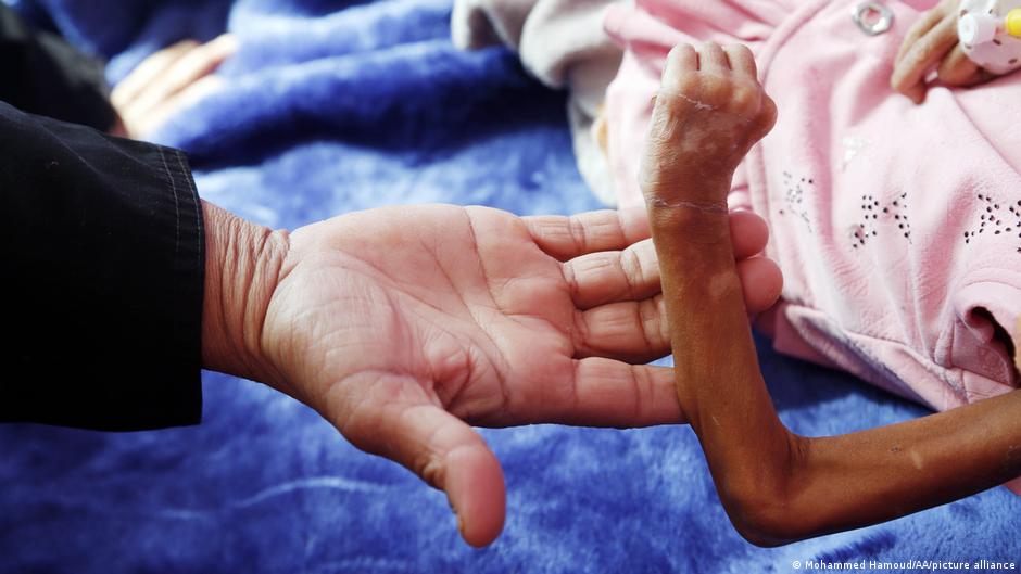 الازمة الإنسانية في اليمن تتفاقم: أطفال يواجهون الجوع والنزوح والتجنيد